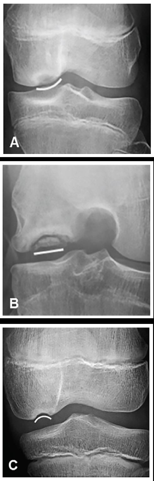 These knee images show the articular side of osteochondritis dissecans (OCD) lesions with predominantly (A) convex, (B) linear, or (C) concave contours. The images were part of a multi-center study reporting that certain radiographic features can be reliably classified by multiple observers. This will allow for the determination of predictors of OCD healing with non-operative or operative treatment.